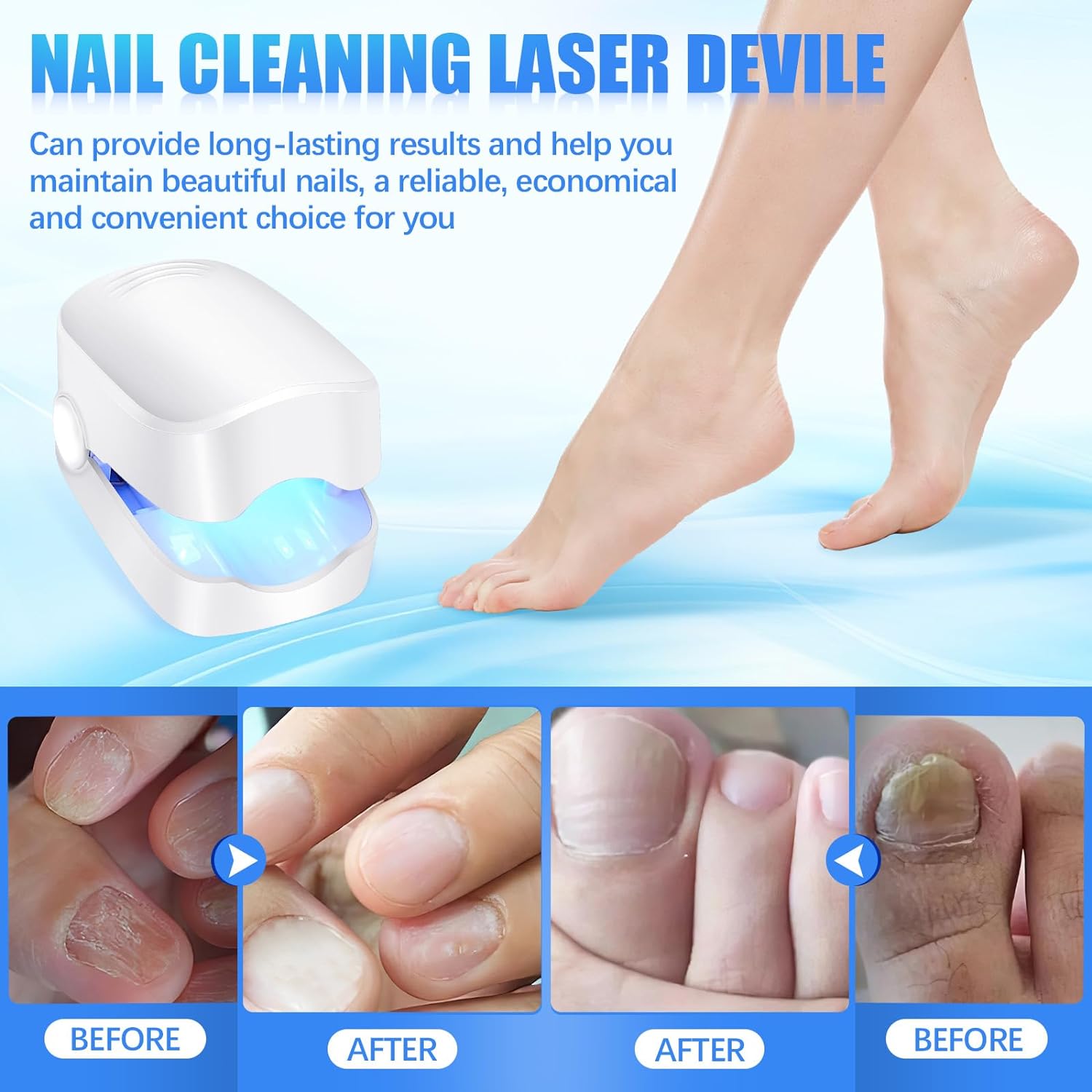 Rechargeable Nail Fungus Laser – Anti-Fungal Device for Toenails, Hands & Feet (Home Use) - Image 6