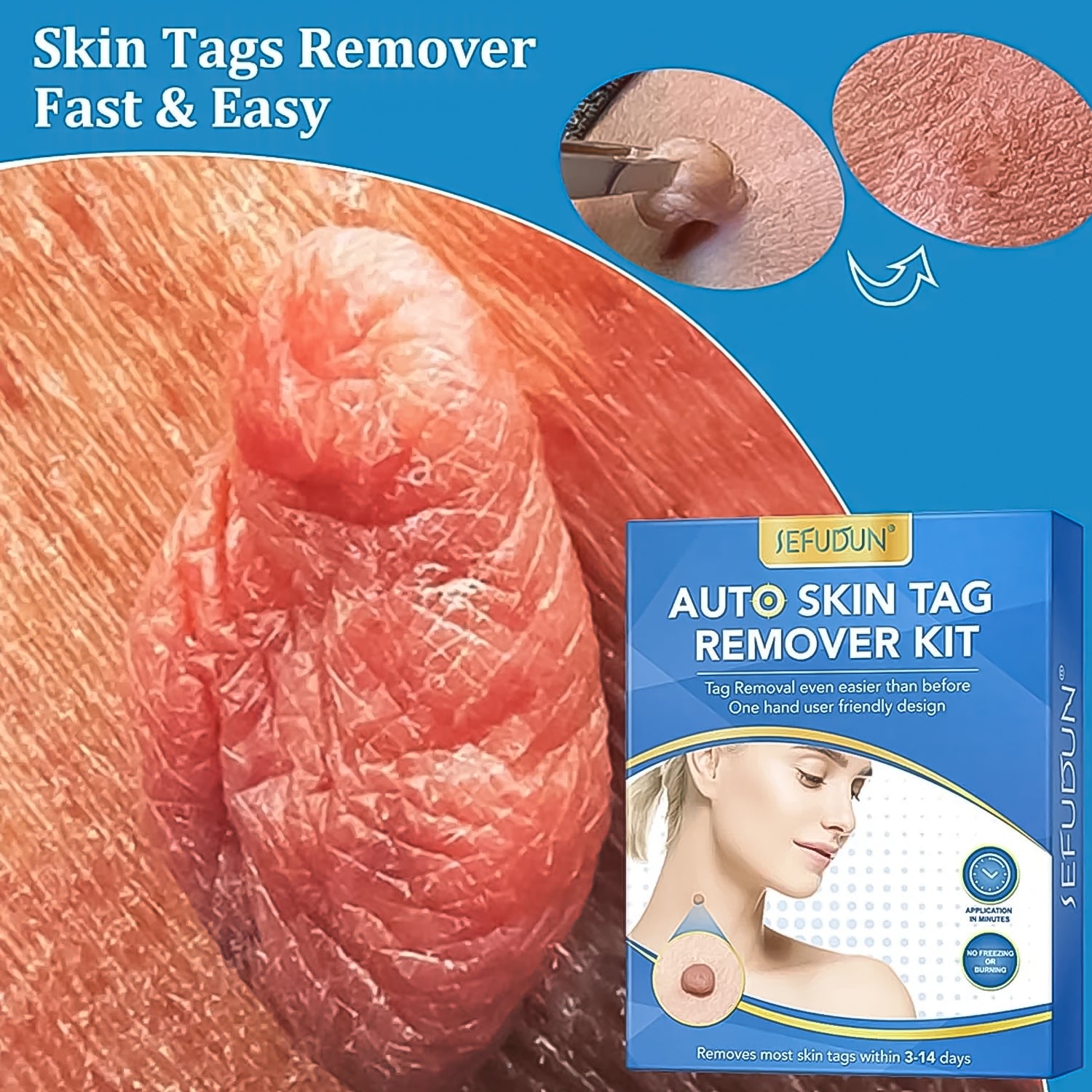 Skin Tag Remover Kit 2 in 1 for Micro to Large (2 mm - 8 mm / 1 Set) - Image 4