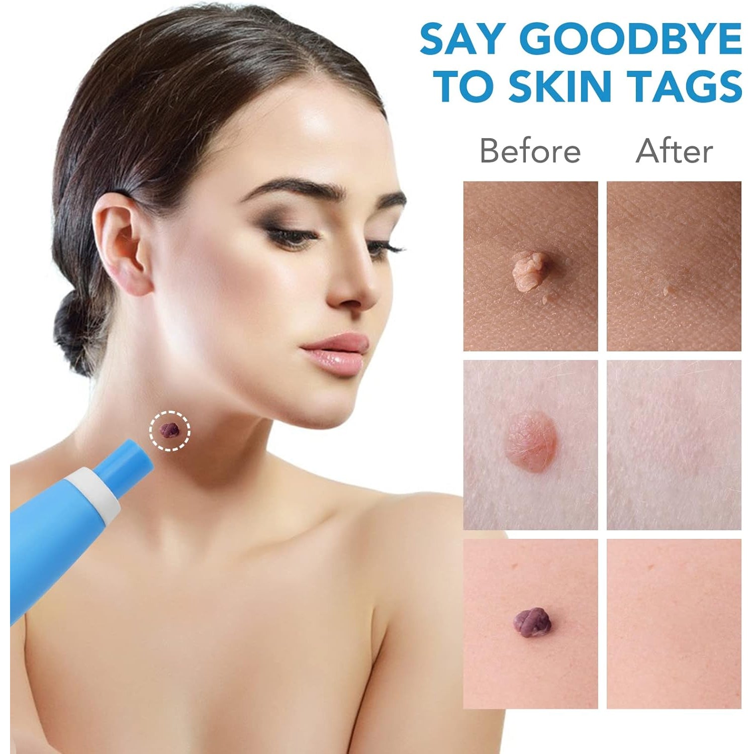 Skin Tag Remover Kit 2 in 1 for Micro to Large (2 mm - 8 mm / 1 Set) - Image 6